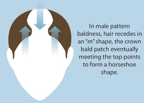 Hair Loss Pattern